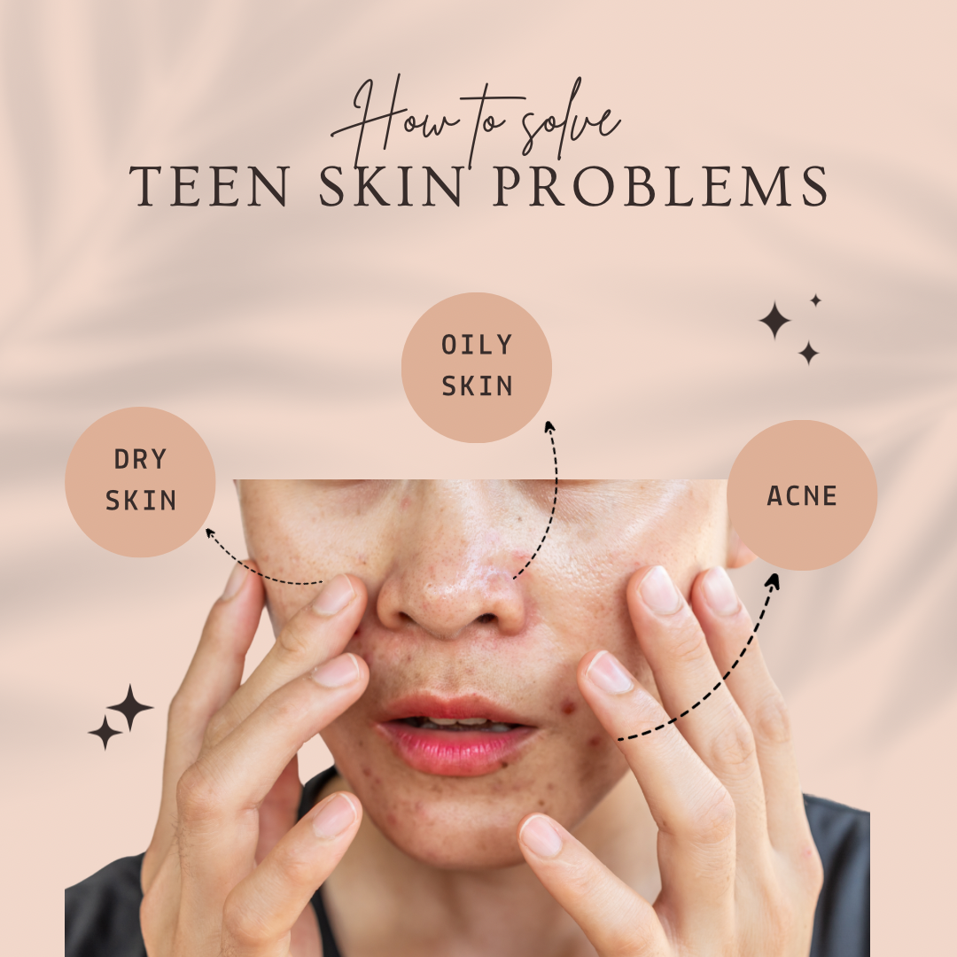 Combating Teen Skin Issues: Oily Skin, Dry Skin & Ance
